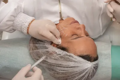 curso de bioestimuladores faciais